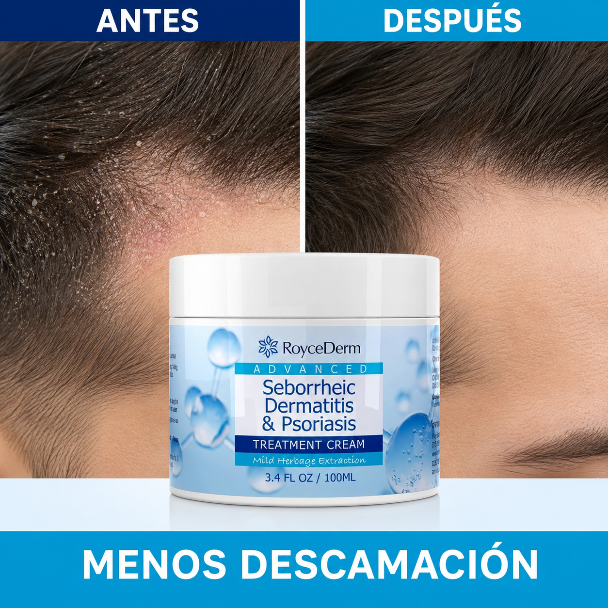 RoyceDerm – Crema para Dermatitis y Psoriasis 100 ml