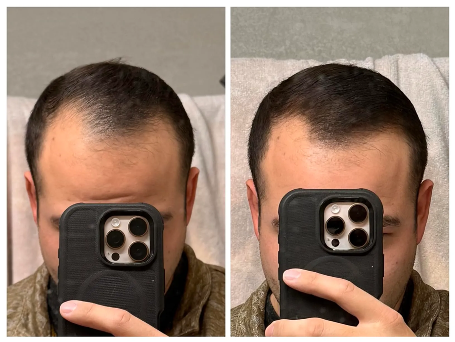 Fotos de un cliente comparando el aspecto de su línea frontal